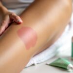 Brûlure après épilation laser du maillot : 5 gestes essentiels à adopter en urgence et soins recommandés
